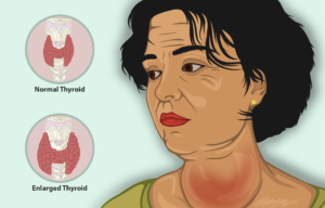 Thyroid goiter 1