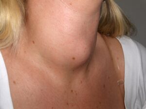 Thyroid goiter