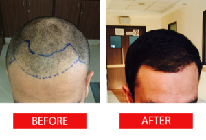 Hair transplant